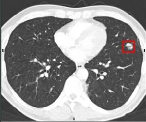 Lung Cancer Screening CT